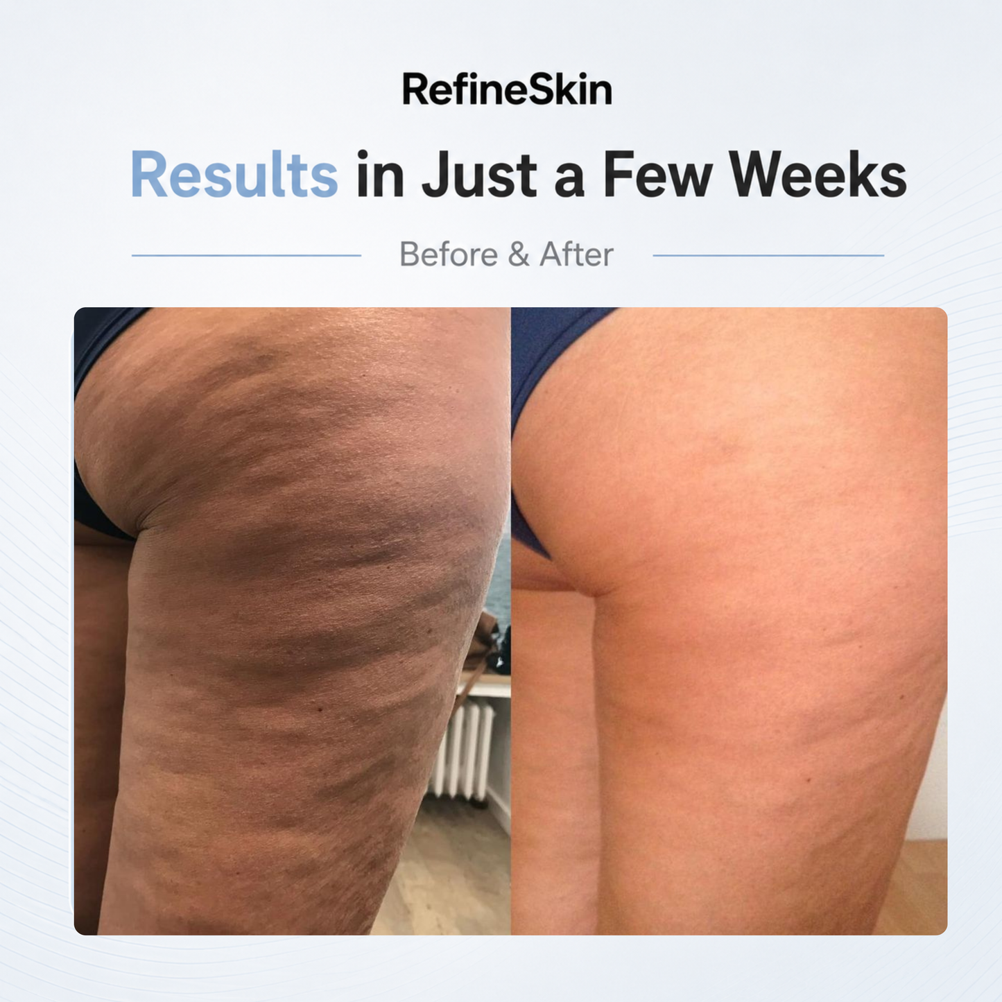 RefineSkin SculptRoll™